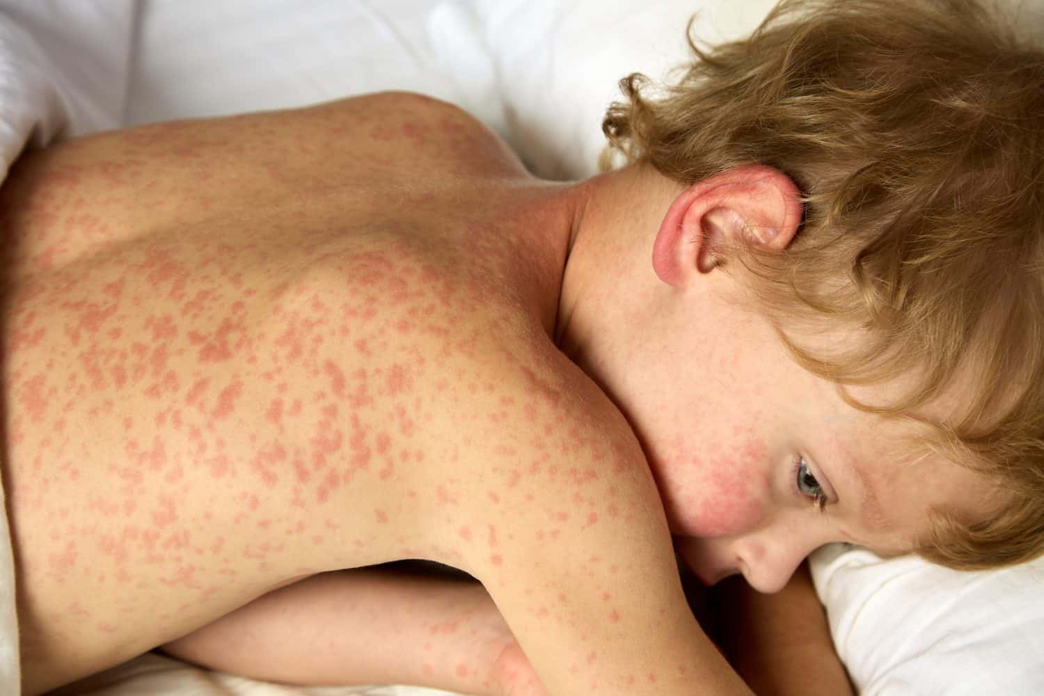 View from above of a sad boy lying on a bed, courageously enduring an unpleasant illness. The child has rubella, lies in bed, rash all over the body