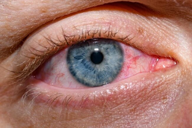 Red-Dry-Blue-Open-Eye-777×518.jpg