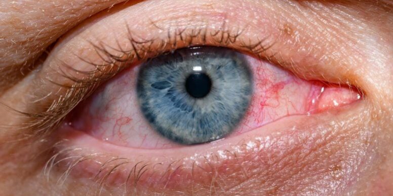 Red-Dry-Blue-Open-Eye-777×518.jpg