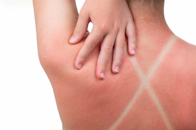 Sunburn-Girl-Back-X-777×518.jpg