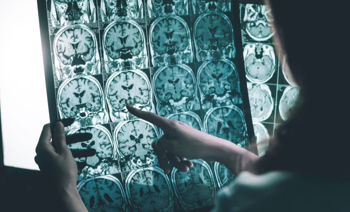 Alzheimer's Disease By Mri